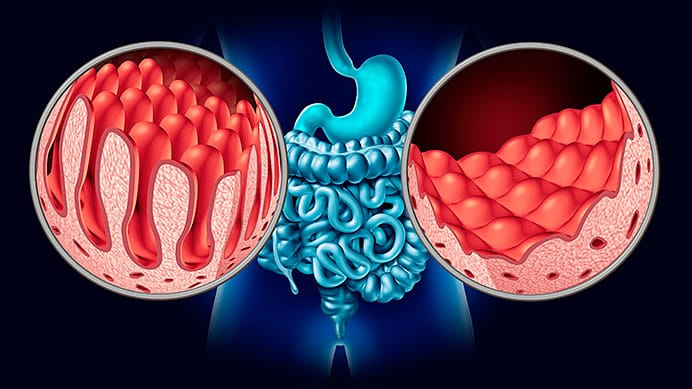 Las 1.000 caras de la Enfermedad Celiaca 1 Representación de un intestino sano (izda.) frente a un intestino con las vellosidades aplanadas que es lo que le ocurre a los celiacos sin diagnosticar (dcha).